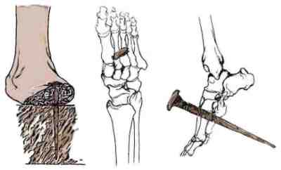 Nail through foot