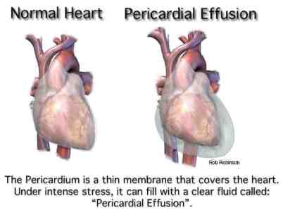Pericardial Effusion